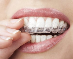 Why Clear Aligners?