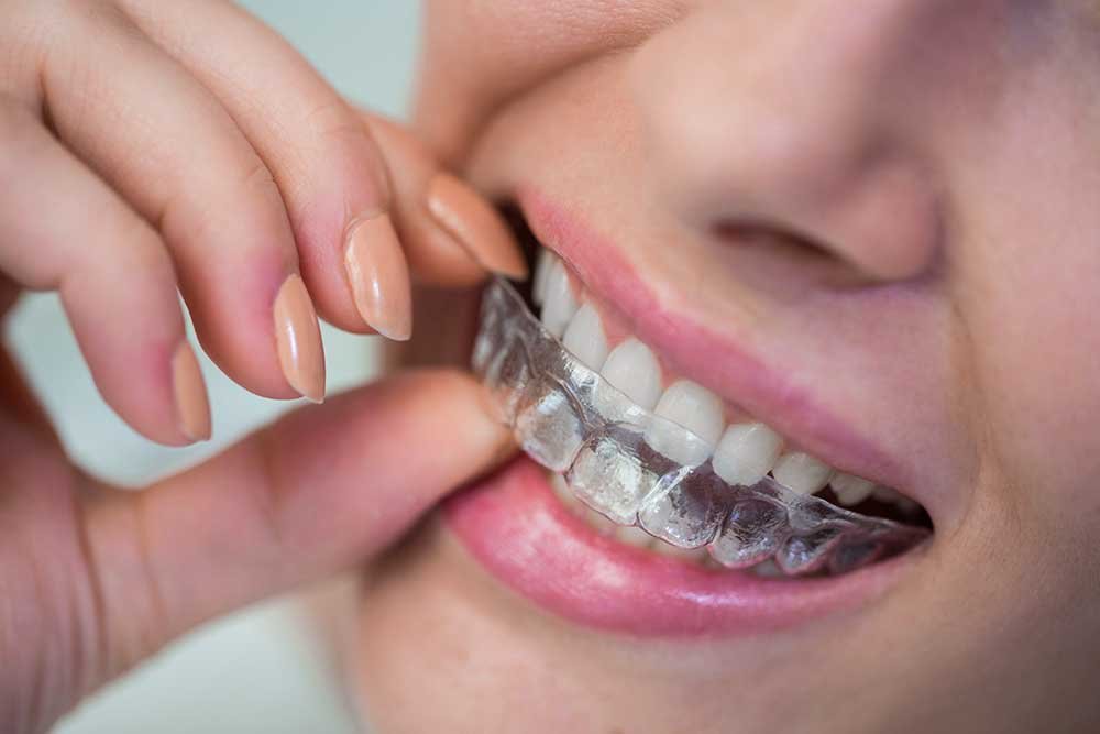 Person inserting clear orthodontic aligner over teeth. Transparent aligner for teeth alignment.