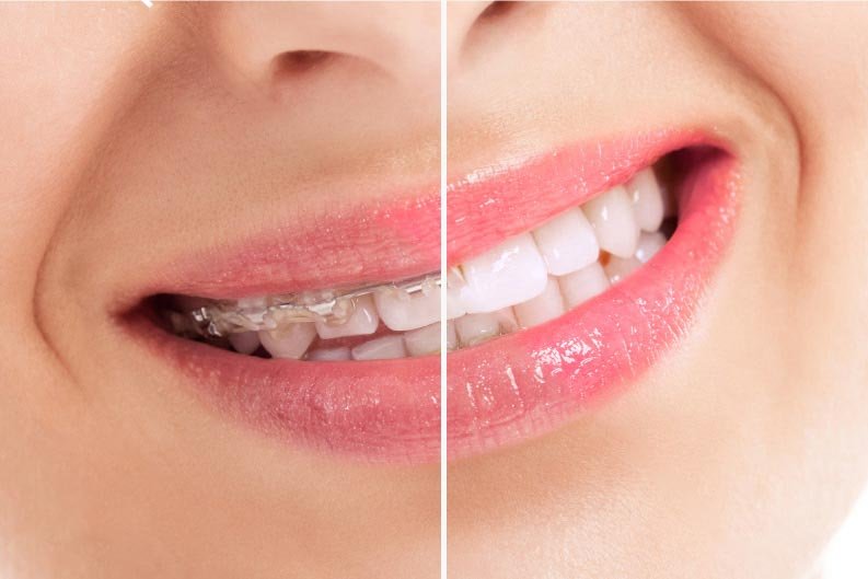 Close-up comparison of teeth before and after treatment with Custom LightForce Braces for Accelerated Orthodontics in Philadelphia.