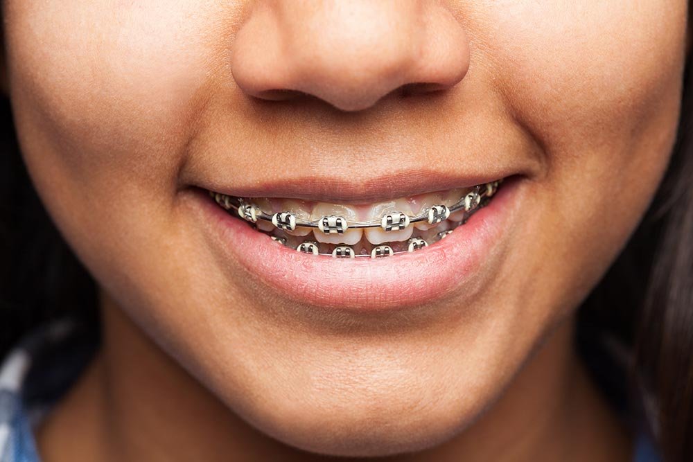 3D-Printed Custom Braces by your Philadelphia Orthodontist : A Faster Path to Perfect Teeth