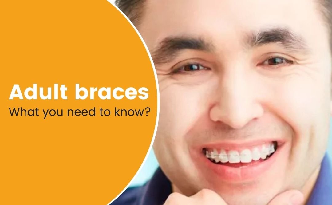 Read more about the article Adult Braces: Benefits, Challenges, and What to Know