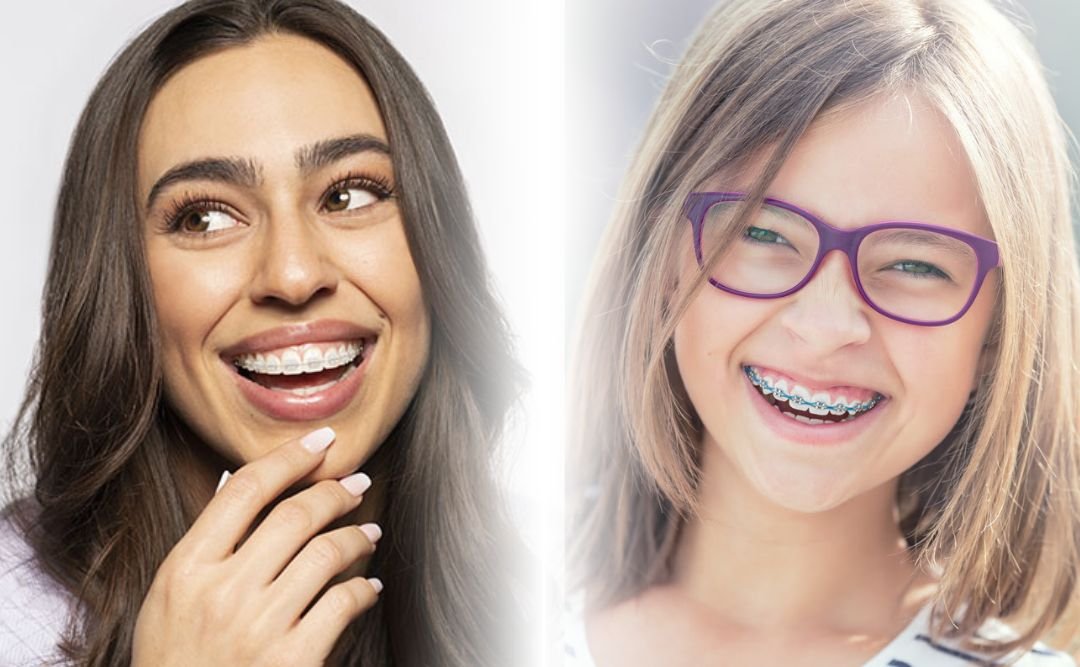 Read more about the article What is the Best Age for Wearing Braces?