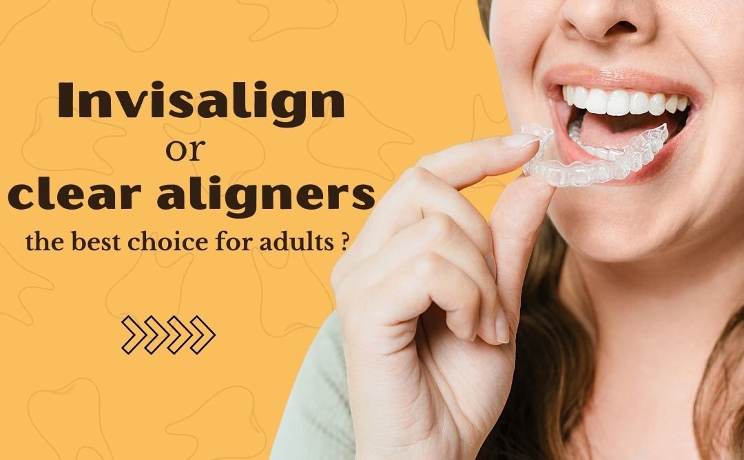 Read more about the article Is Invisalign or Clear Aligners the best choice for adults?