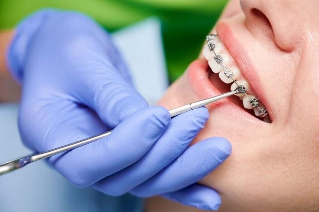 Visuals from the extraction procedure of braces