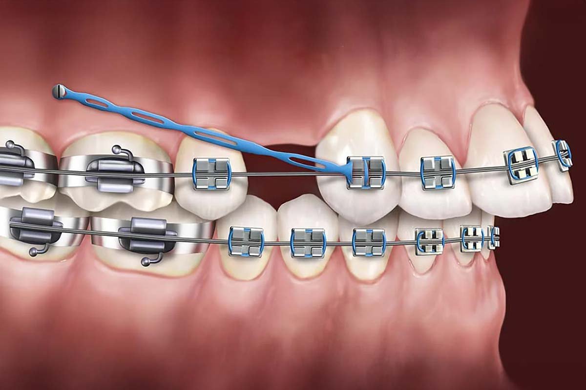 Read more about the article Are You a Candidate for Temporary Anchorage Devices? Detailed Guide