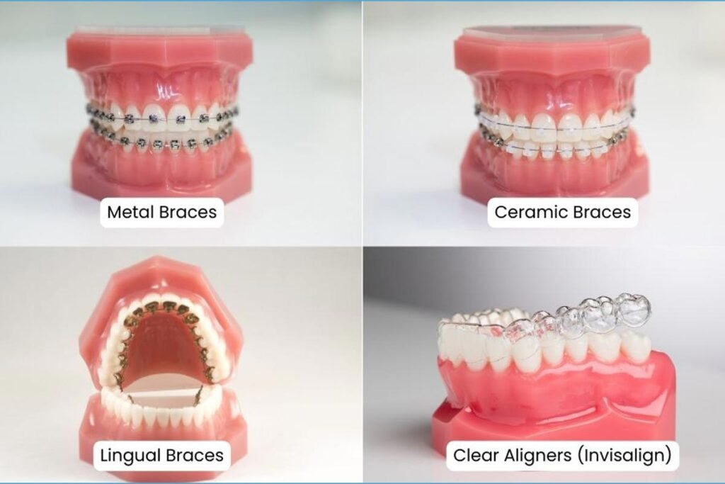 Visual representation of different braces or aligners to choose