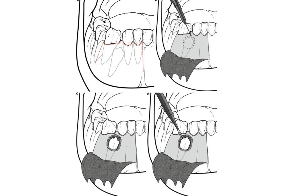 Visual representation of Impacted Canines treatment procedure