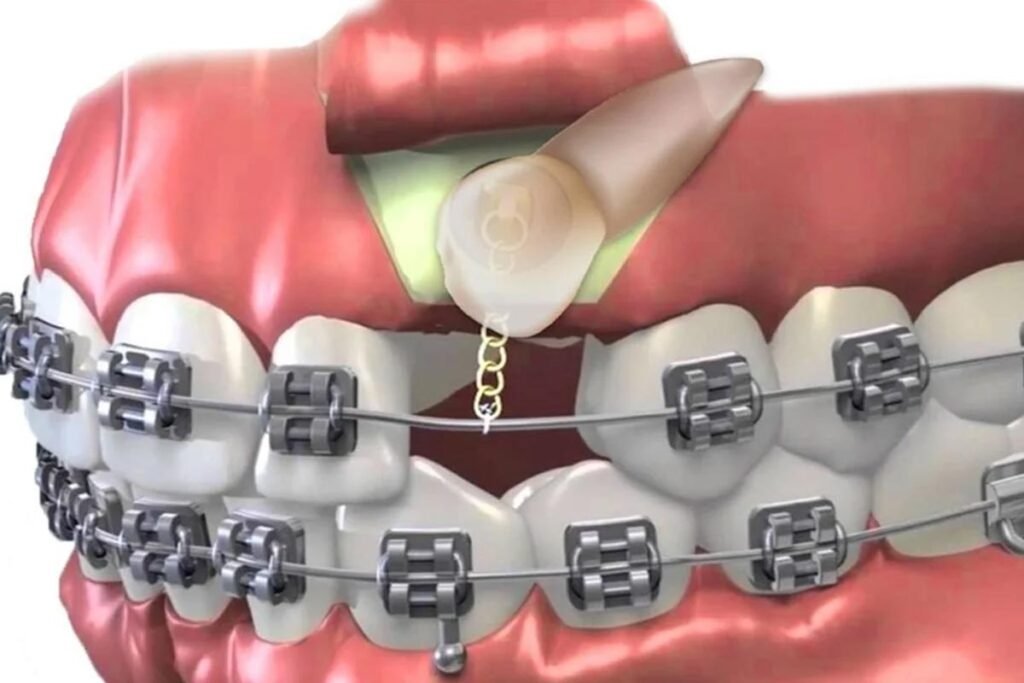 Visual representation of Impacted Canines extraction