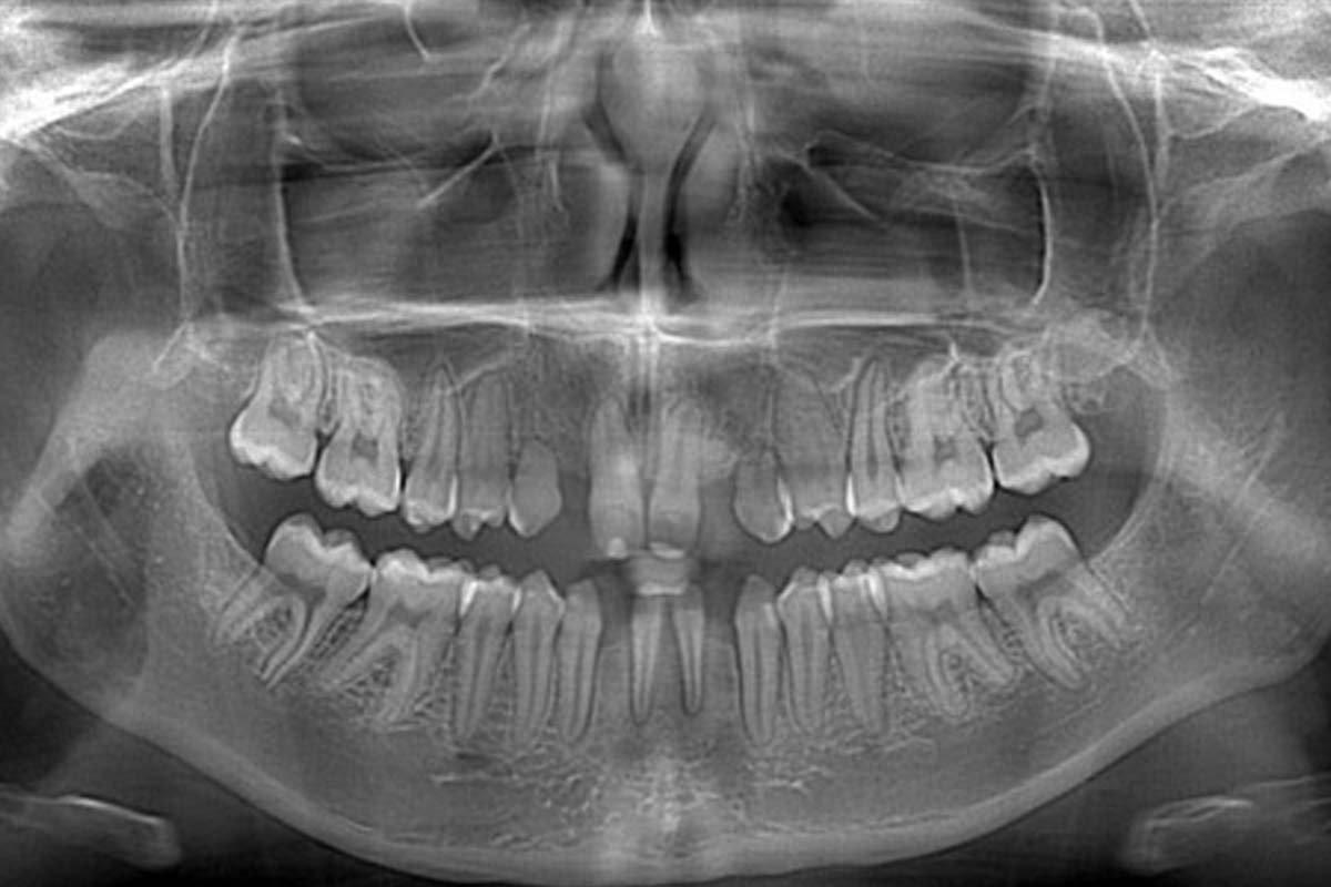 Read more about the article Hypodontia in Orthodontics: Diagnosis & Treatment