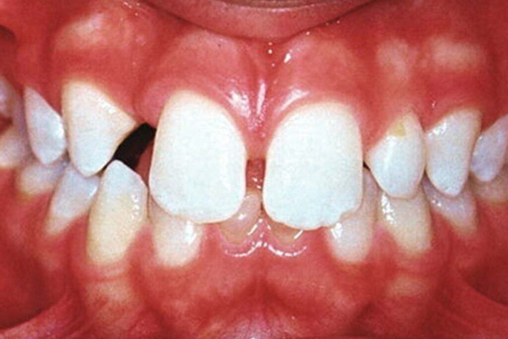 Hypodontia Causes 