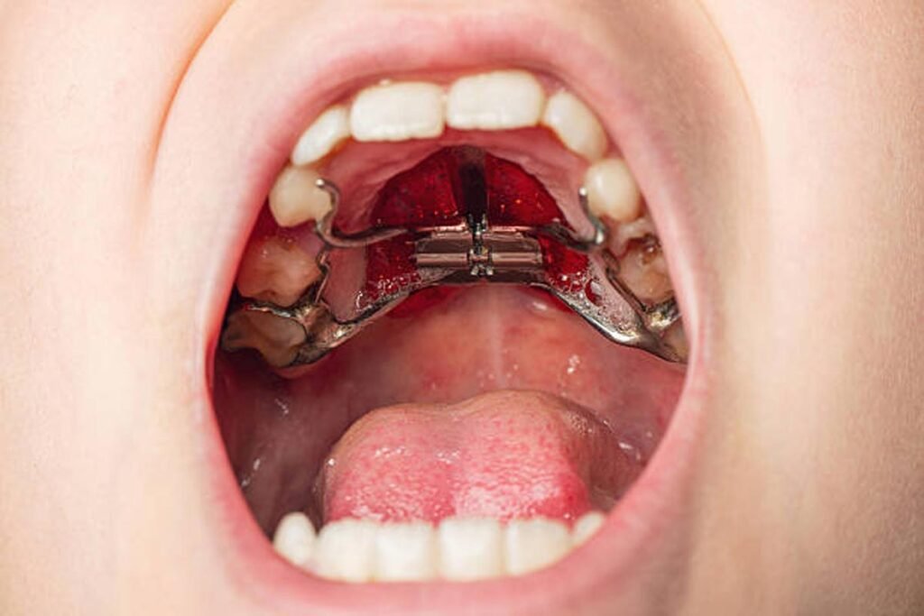Palate Expander