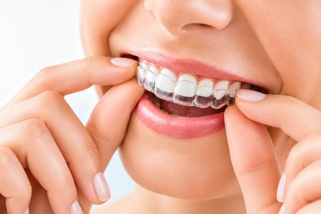 Invisalign attachment 